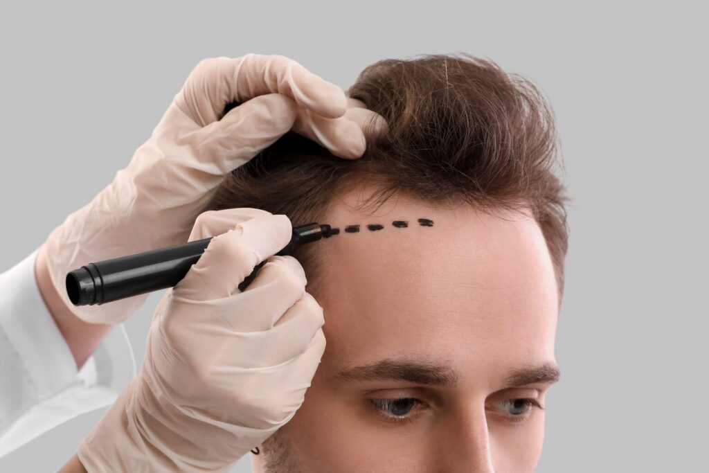 Hair Transplant: Surgery, Methods, Candidates & Results