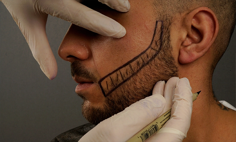 Beard Transplant in Antalya